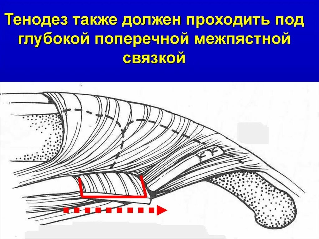 Транспозиция сухожилий. Тенодез сухожилия длинной головки плеча. Тенодез длинной головки бицепса.