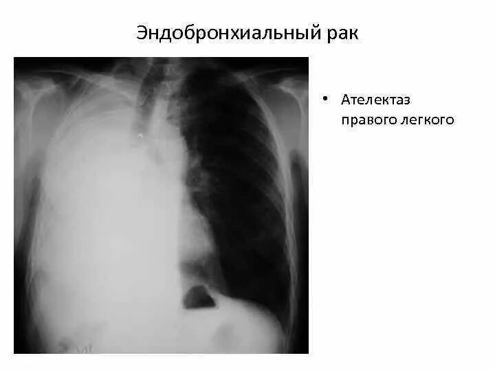 Обтурационный ателектаз рентген. Ателектаз средней доли правого легкого рентген. Ателектаз нижней доли правого легкого рентген. Ателектаз s8 правого легкого. Центральный рак правого