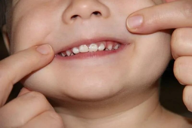 Ребенку 2 года 12 зубов. Бутылочный кариес у детей. Начальный кариес молочных зубов.