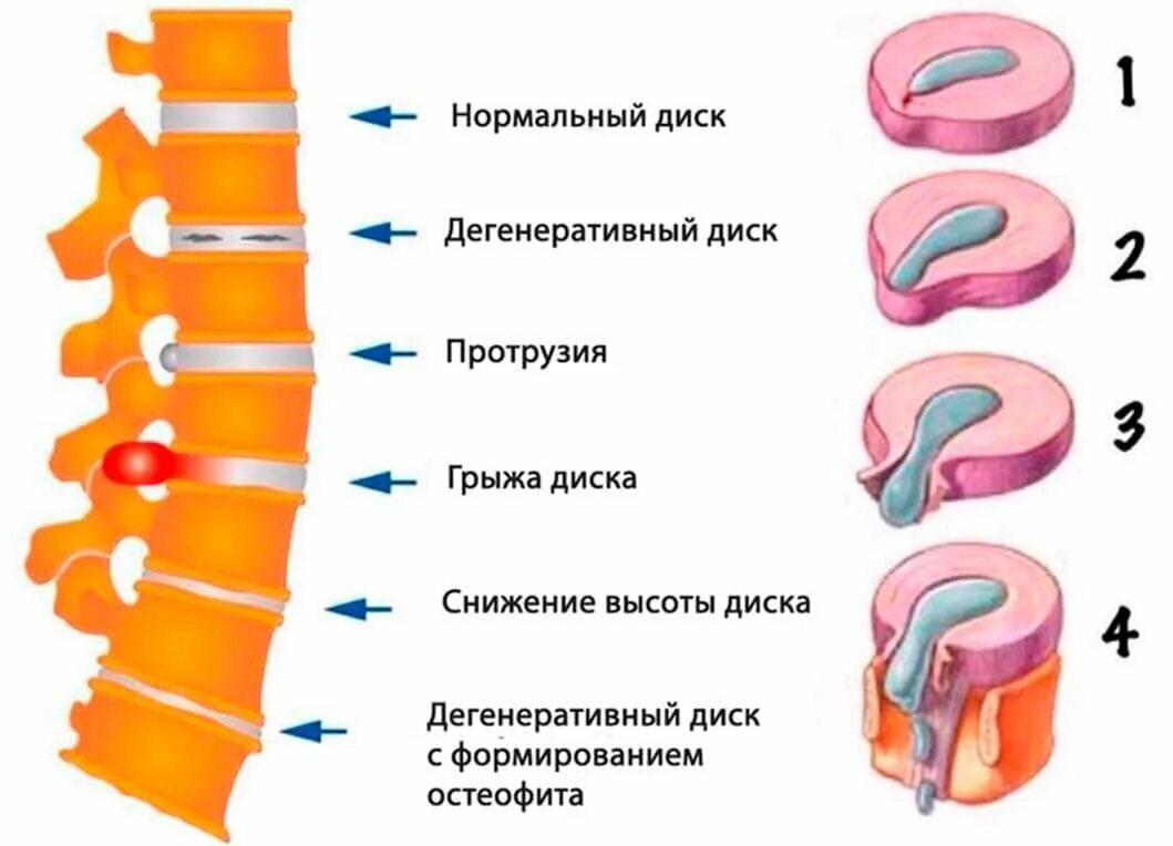 Как лечить грыжу дома