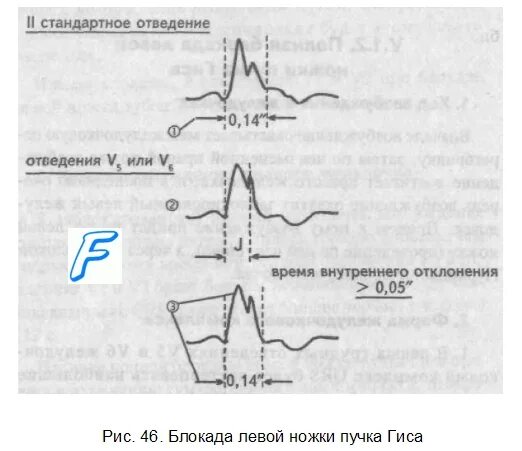 Расщепление зубца