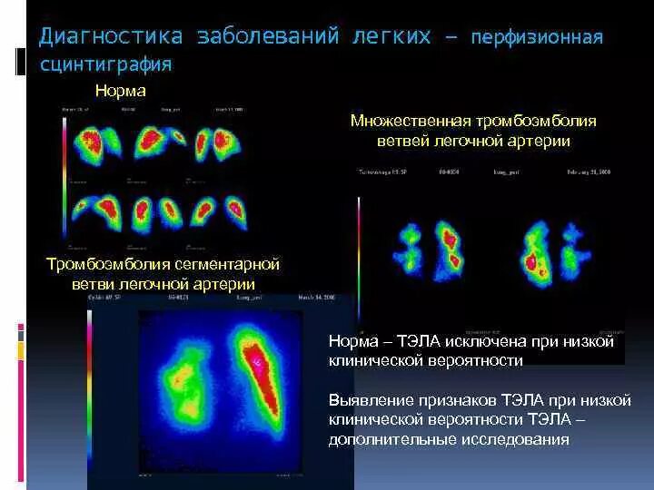 Диагнозы сцинтиграфии. Диагнозы сцинтиграфии
