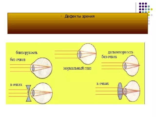 Ход лучей глаза человека. Дальнозоркость и близорукость строение глаза. Глаз близорукость и дальнозоркость физика. Схема близорукости и дальнозоркости. Близорукость и дальнозоркость схема физика.