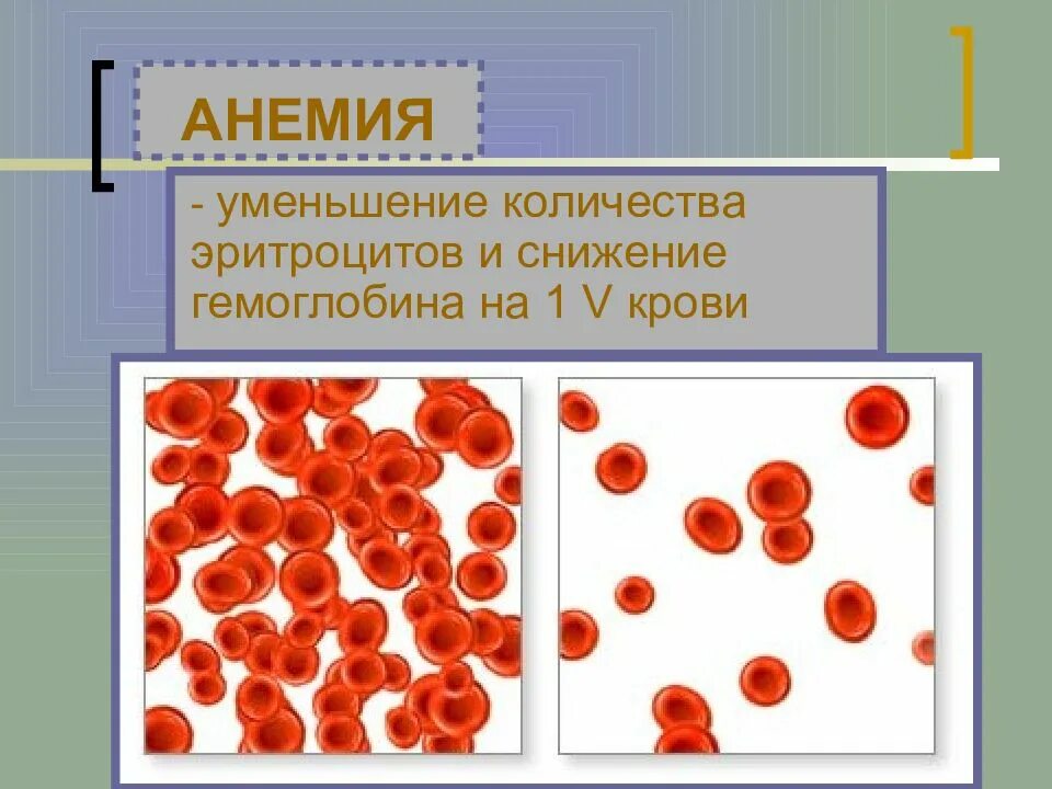 Снижение гемоглобина. Снижение эритроцитов и гемоглобина. Эритроциты анемия. Снижение количества гемоглобина в эритроците. Анемия со снижением эритроцитов.