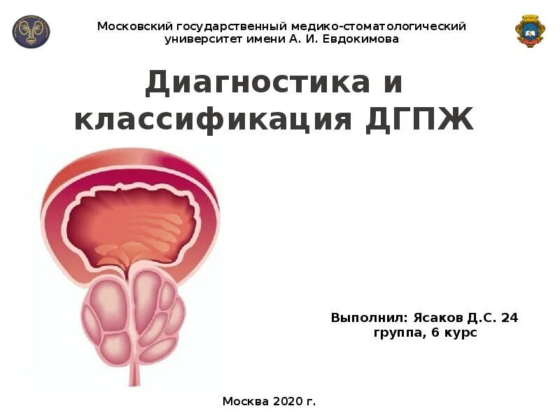 Стадии дгпж. Гиперплазия предстательной железы классификация. Доброкачественная гиперплазия предстательной железы классификация. ДГПЖ степени классификация. Аденома предстательной железы классификация.