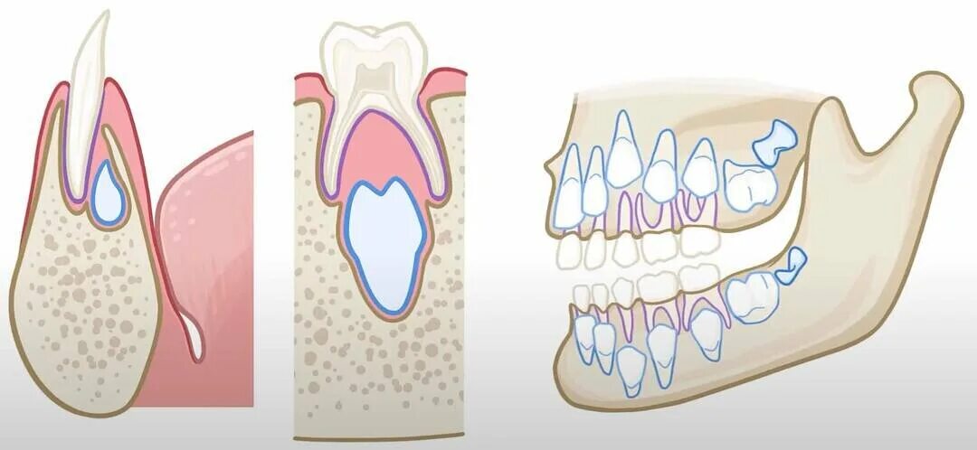 Правильно растущий коренной зуб. Выпал коренной зуб что делать. Растут зубы коренные молочные не выпали. Что делать если у ребенка не выпал коренной зуб.