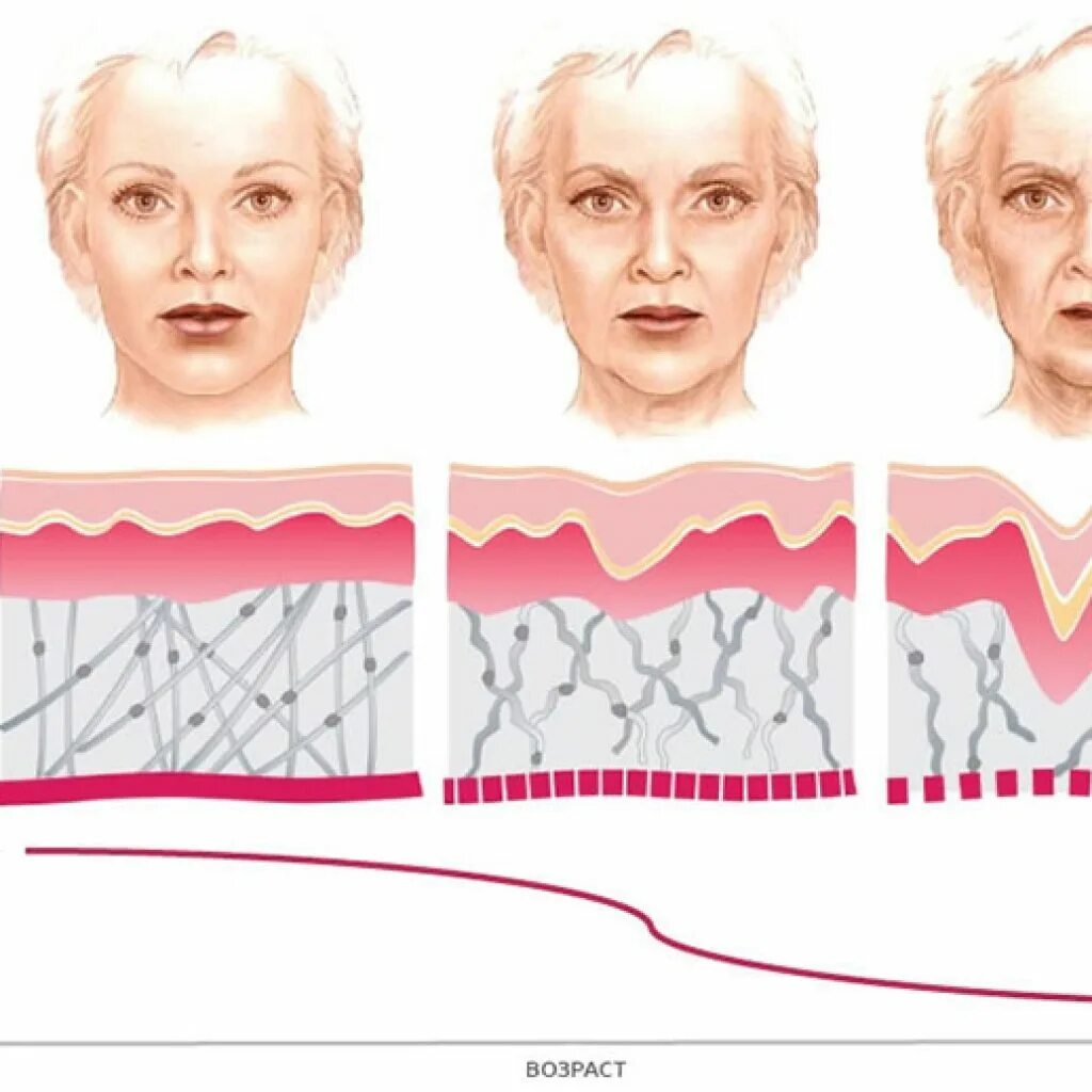Возрастные изменения кожи лица. Возрастные измененияожи. Процесс старения кожи. Старение кожи схема.