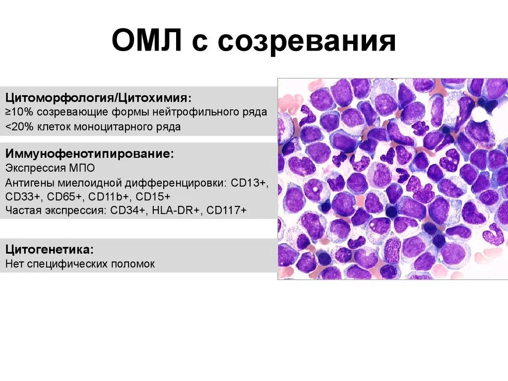 Острый миелоидный лейкоз прогноз. Острый миелобластный лейкоз (ОМЛ). Миелоидный лейкоз микроскопия. Острый миелоидный лейкоз исследования крови. Острый миелобластный лейкоз с минимальной дифференцировкой.