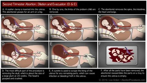 Abortionist: Abortion includes pulling out the baby in pieces D&E Abortion