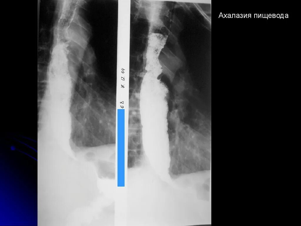 Ахалазия кардии рентген. Диагностика ахалазии пищевода. Ахалазия пищевода фото. Халазия пищевода