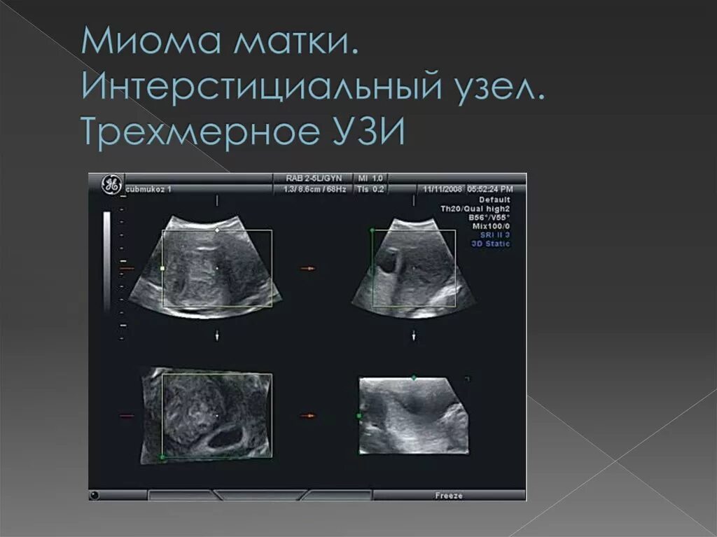 УЗИ множественная миома. Миома интерстициальная субсерозная что это. Интерстициальная миома. Ультразвуковые критерии миомы матки. Миома на задней стенке матки