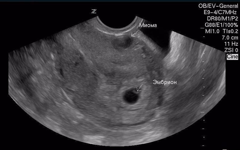 плодное яйцо в матке узи. цветовое допплеровское картирование миома матки. можно перепутать миомой. миома матки и беременность узи. нарушение питания миоматозного узла на узи.