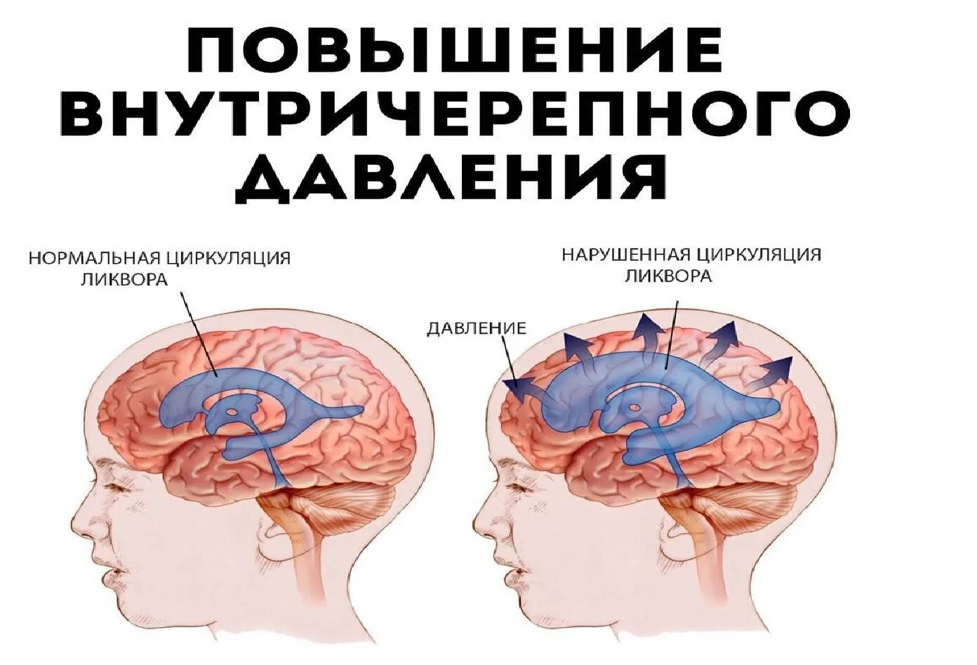 Почему давят глаза и виски. Черепной давления и головной боль. Внутричерепное давление. Головная боль при внутричерепном давлении. Внутричерепное давление глазное дно.