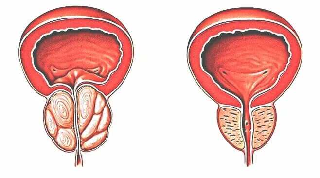 Аденома предстательной железы рисунок. Аденома предстательная железа у мужчин. Простит аденома простаты. Красивая простата