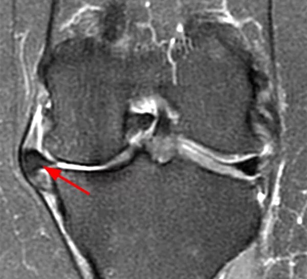 Повреждение медиального мениска коленного сустава мрт. Разрыв медиального мениска коленного сустава рентген.