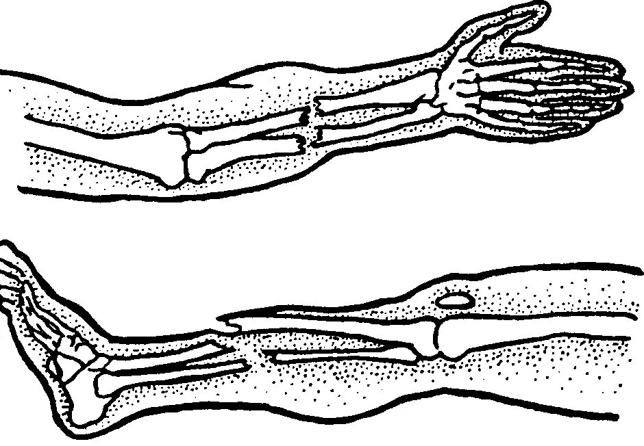 закрытые повреждения переломы. закрытые повреждения переломы. закрытые повреждения переломы. открытый перелом берцовой кости. переломы костей конечностей.