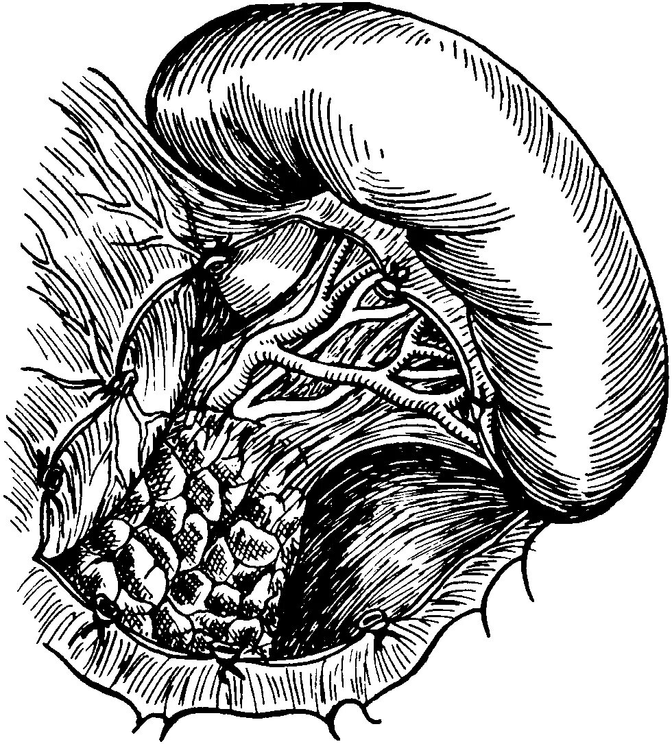 Спленэктомия Оперативная хирургия. Спленэктомия селезенки. Желудок селезенка анатомия.