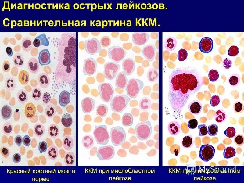 Пересадка при лейкозе. Стернальная пункция острый лейкоз. Красный костный мозг при миелолейкозе. Костный мозг при лимфобластном лейкозе. Костный мозг при остром миелобластном лейкозе.