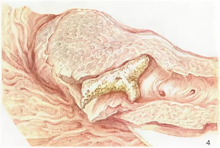 Камни в поджелудочная железа симптомы лечение. Камни поджелудочной железы. Камни из поджелудочной железы. Камни в протоках поджелудочной железы.