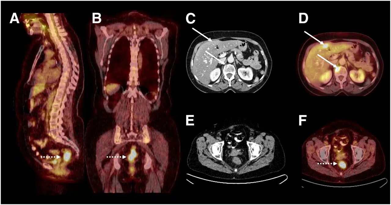 ПЭТ кт с контрастированием. ПЭТ-кт опухоль позвоночника. ПЭТ/кт Discovery Pet/CT 610. ПЭТ кт , мрт, кт. Разница кт и кт с контрастом