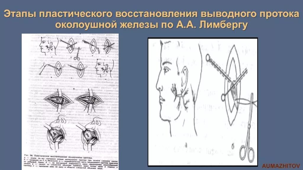 Операция околоушной слюнной железы. Субтотальная резекция слюнной железы. Операции на слюнных железах. Резекция околоушной железы. Операции околоушная железа