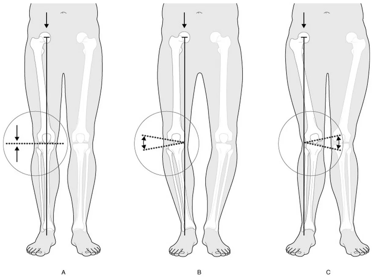 Вальгус и Варус. Вальгус и Варус коленных суставов. Тесты на коленный сустав