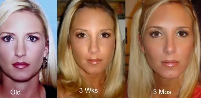 через год ринопластики