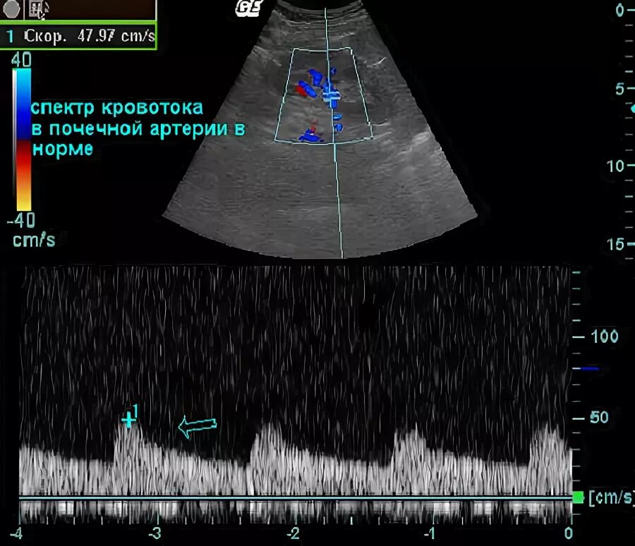 левый кровоток. правая и левая коронарные артерии отходят от. узи допплер маточно плацентарного кровотока. открытый артериальный проток гемодинамика порока. реверсный кровоток в венозном протоке показатели пи -1.