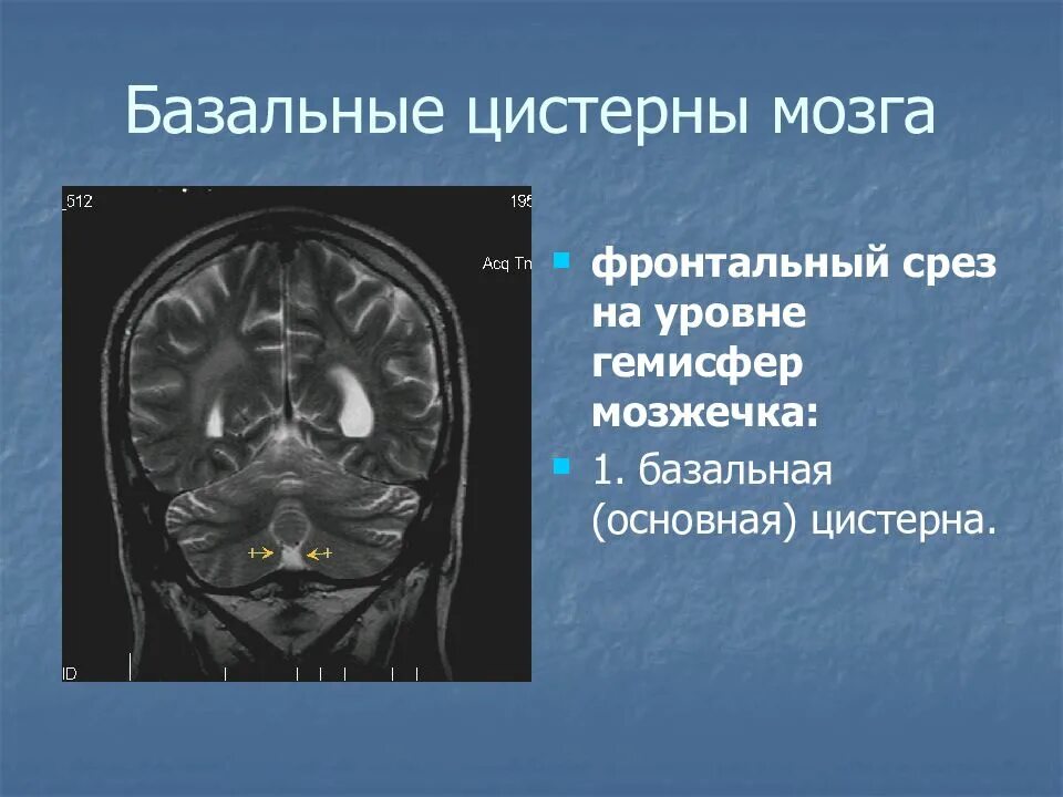 Цистерны мозга расширены. Базальные цистерны на мрт головного. Базальные цистерны головного мозга на мрт. Цистерны мозжечка анатомия. Супраселлярная цистерна мрт.