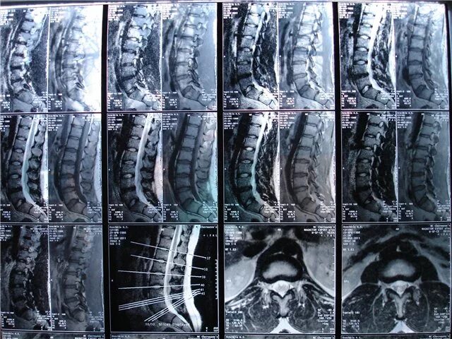 Грыжа 6 мм. Неоперабельные грыжи позвоночника. Межпозвоночная грыжа поясничного отдела 7мм. Межпозвоночная грыжа крестцового отдела операция. Размер грыжи поясничного отдела позвоночника для операции.