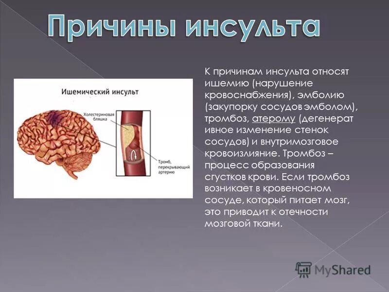 Причинами инсульта могут быть. Причины инсульта. Основные причины ишемического инсульта. Ишемический инсульт причины возникновения. Предпосылки ишемического инсульта.