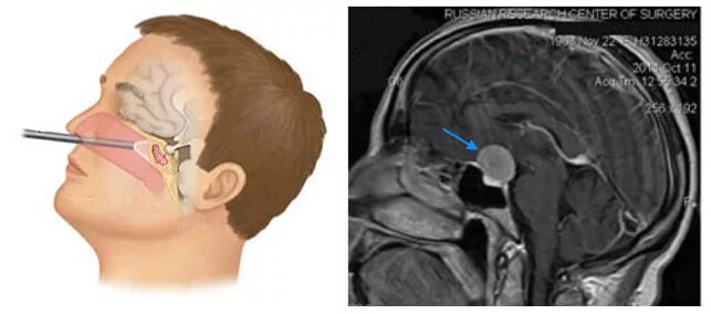 Менингиома бугорка турецкого седла. Менингиома турецкого седла мрт. Менингиома бугорка турецкого. Операция менингиома головы. После операции менингиомы головного мозга