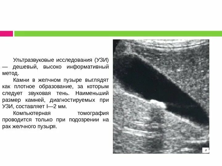 Узи жкб. Сонограмма камней в желчном пузыре. Холестероз желчного пузыря. Конкременты желчного пузыря УЗИ. УЗИ желчного пузыря ЖКБ.