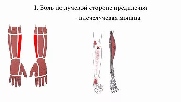 Боли мышц предплечья как лечить. Болят мышцы предплечья. болит предплечье левой руки. болит мышца предплечья левой руки.