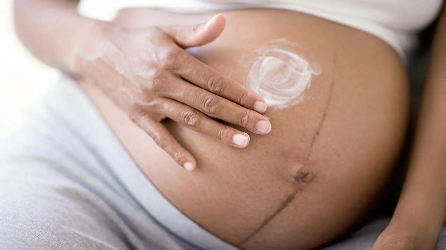 Полоска на животе при беременности. Полоса на животе у беременных. Полоска на животе у беременной. Пигментная полоса на животе при беременности.