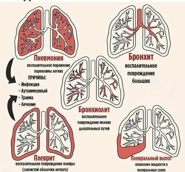 Болезнь легких перечень. Болезни лёгких у человека перечень. Заболевания легких названия. Болезнь лёгких название список. Виды заболевания легких.
