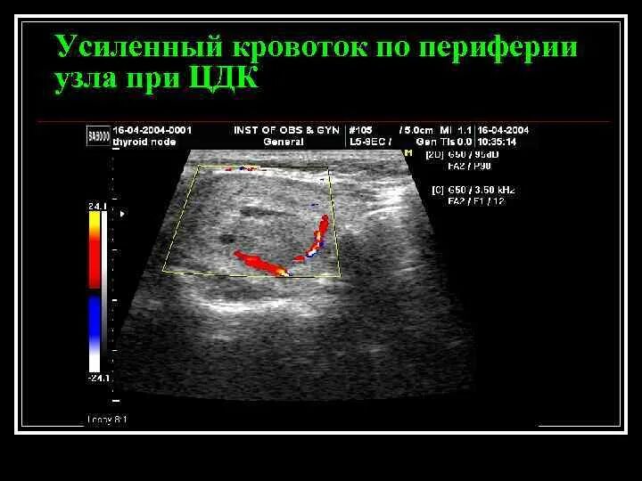 При ЦДК кровоток по периферии. Кровоток щитовидной железы УЗИ. При ЦДК кровоток не определяется. Цдк лимфоузлов