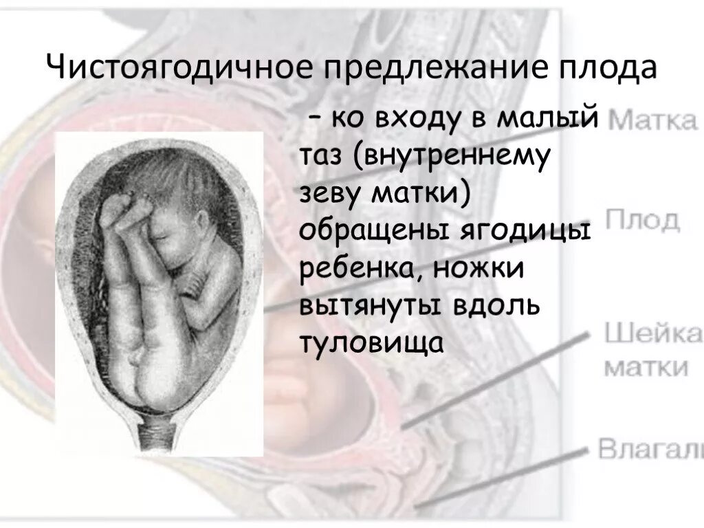 Тазовое предлежание матки. Плодное предлежание плода. ягодичное предлежание плода. тазовое ягодичное предлежание.