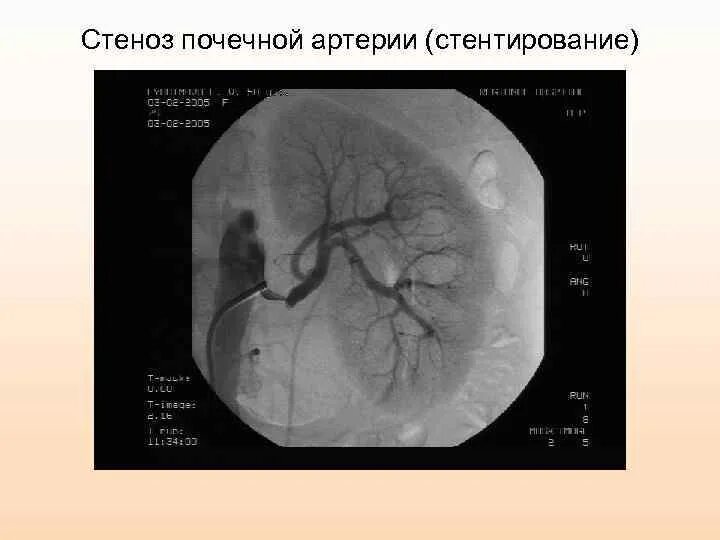 Стеноз почечной артерии кт. Тромбоз почечной артерии кт. Фибромускулярный стеноз почечной артерии. Фибромускулярная дисплазия почечной артерии. Тромбоз почек