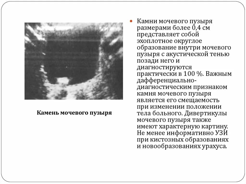 Размеры камней в мочевом. Цистиновые камни в мочевом пузыре. Цистиновые камни в мочевом пузыре у мужчин. Размеры камней в мочевом. Размеры камней в мочевом.