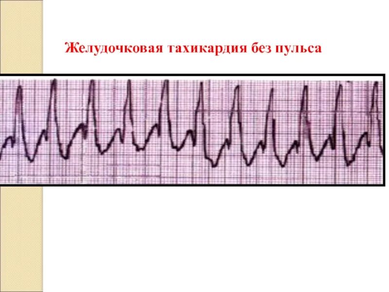 Желудочковая тахикардия на экг. Беспульсовая желудочковая тахикардия. Фибрилляция желудочков без пульса ЭКГ. Пароксизмальная желудочковая тахикардия и трепетание желудочков. Желудочковая тахикардия без пульса на ЭКГ.