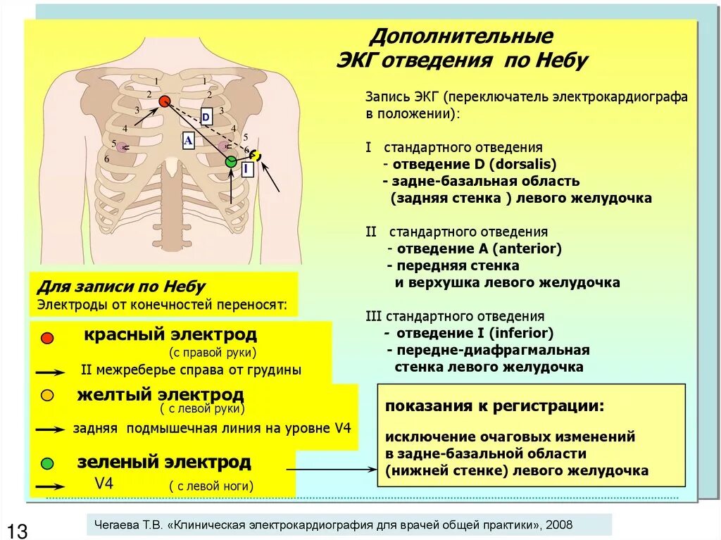 ЭКГ по небу наложение электродов. Методика снятия ЭКГ по небу. Снятие ЭКГ электроды отведения. ЭКГ по небу расположение электродов. Соп экг