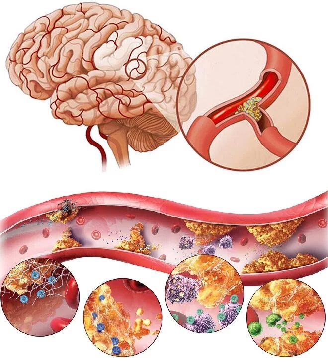 Инсульт холестерин. Атеросклероз артерий головного мозга. Атеросклероз бляшки сосудов. Атеросклероз сосудов головного мозга симптомы. Атеросклероз церебральных сосудов симптомы.