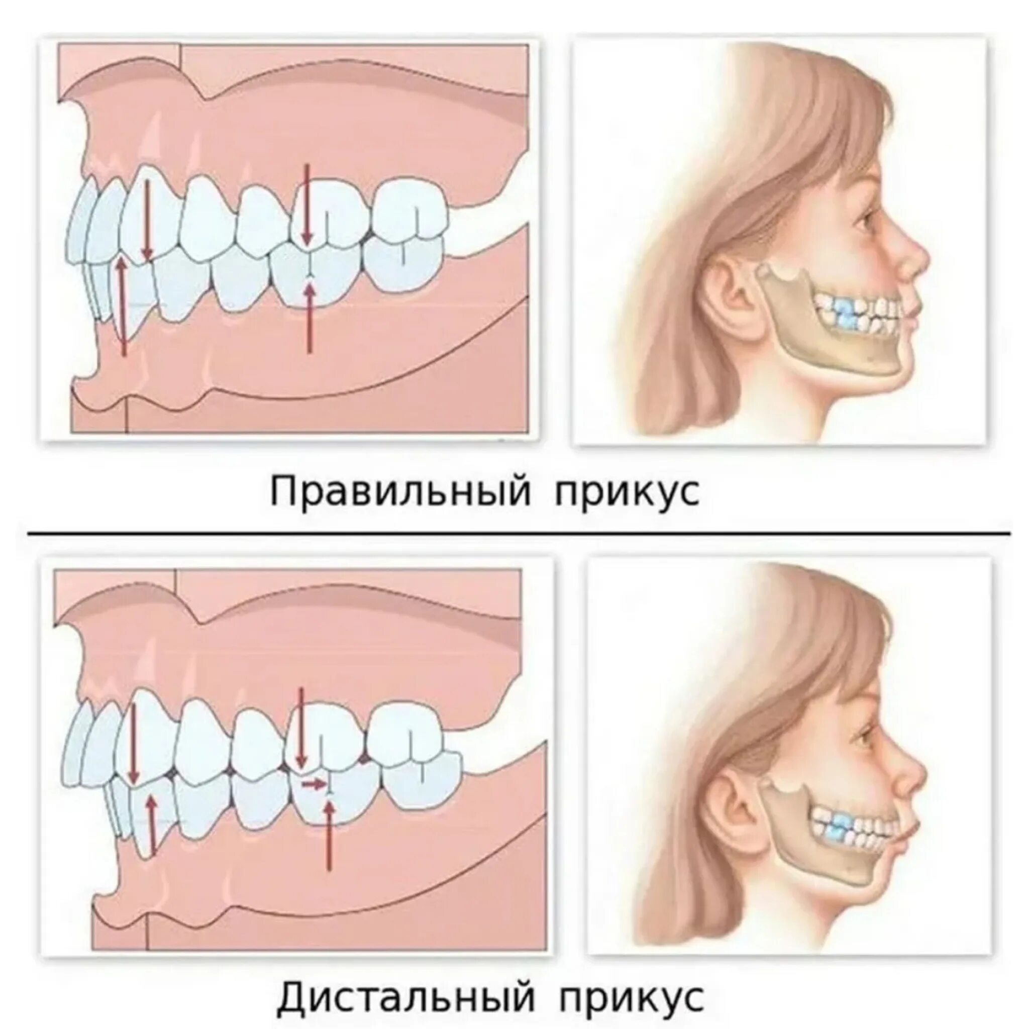 Дистальный (прогнатический) прикус. Дистальный и мезиальный прикус. Дистальный прикус прогнатия.