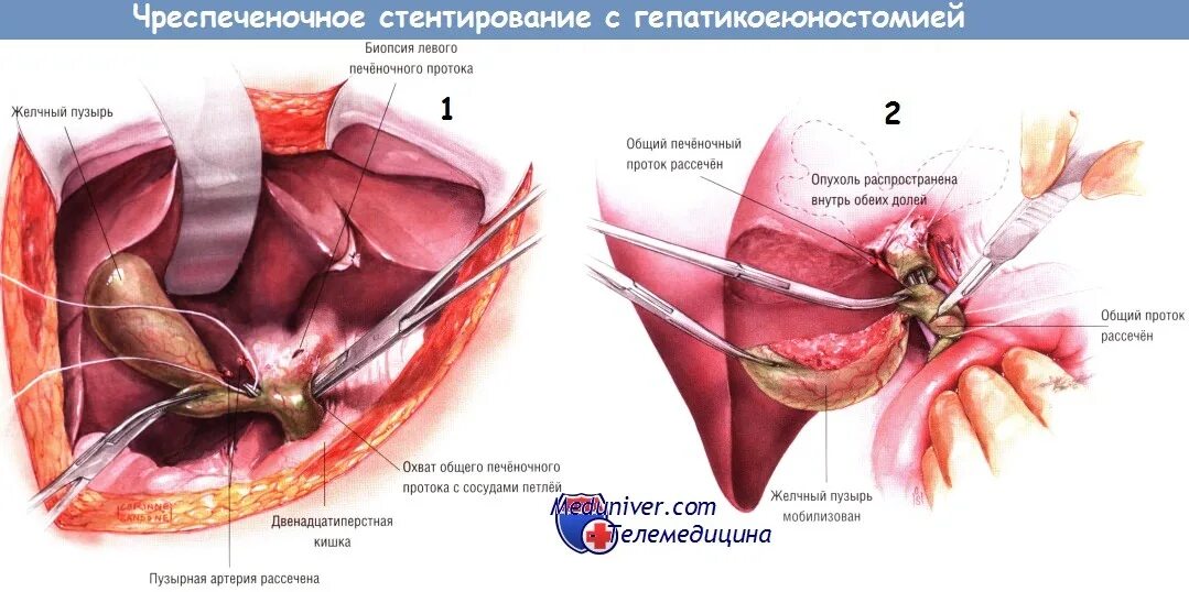 Стент желчного протока