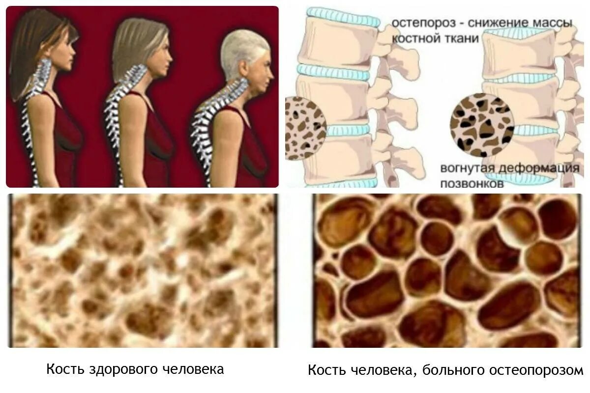 Структура костной ткани остеопороз. Структура кости при остеопорозе. Остеопороз костей позвоночника. Возрастной остеопороз. Изменение структуры кости