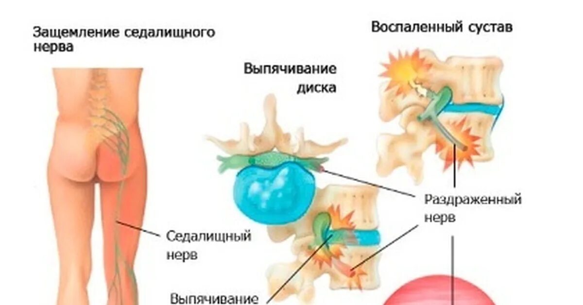 Блокада при защемлении седалищного. Седалищный нерв картинка. Нерв в ягодице. Расположение седалищного нерва на ягодице.