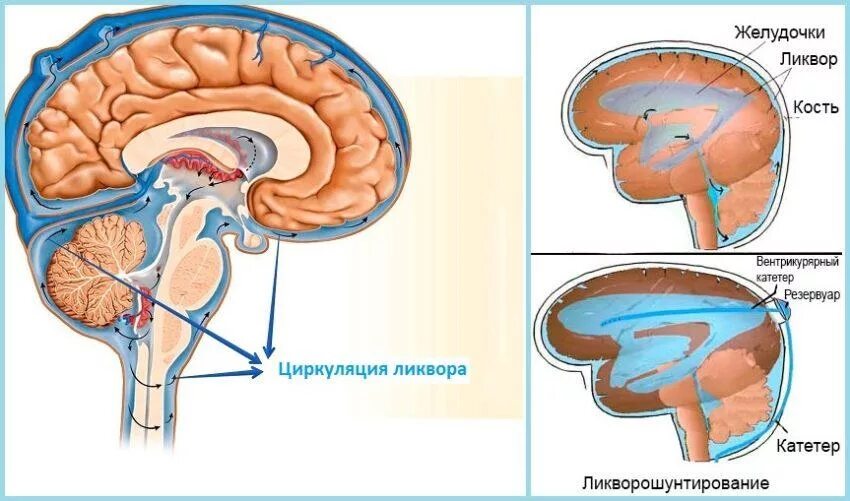 Гидроцефалия шунтирование мозга. Отогенный менингит ликвор. Циркуляция ликвора в головном мозге. Циркуляция спинномозговой жидкости. Схема циркуляции ликвора.