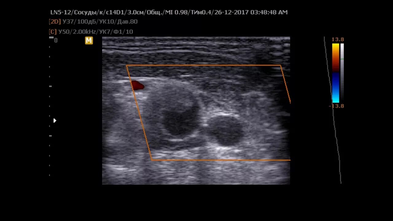 Аневризма подколенной артерии на УЗИ. Аневризма общей сонной артерии на УЗИ. Тромбоз яремной вены на УЗИ. Тромбоз аневризмы брюшной аорты УЗИ. Узи вен тромбоз