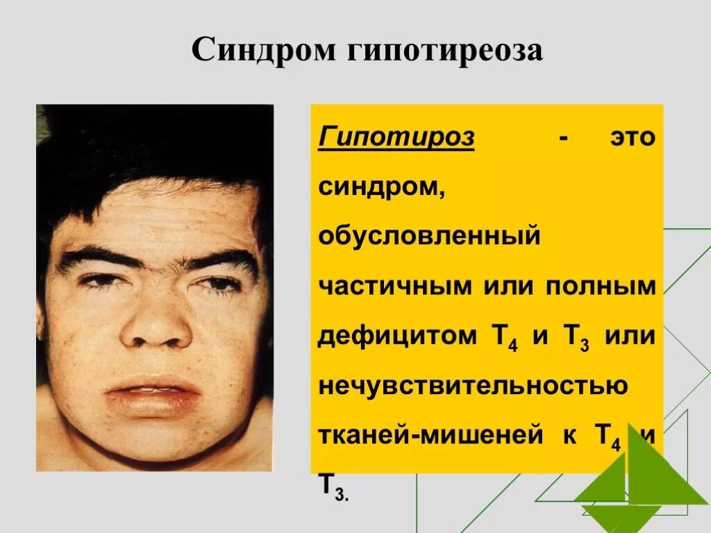 Врожденный гипотиреоз синдромы. Гипотиреоз внешние проявления. Синдромы при гипотиреозе.